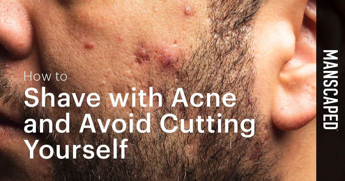 Does Trimmer Cause Acne?